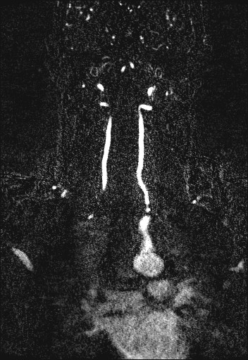 Carotid artery dissection (Radiopaedia 28441-28689 Coronal MRA 60).jpg