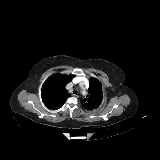 File:Carotid body tumor (Radiopaedia 21021-20948 B 29).jpg