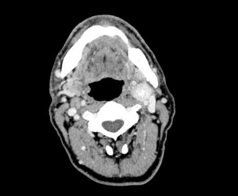Carotid body tumor (Radiopaedia 61750-69757 Axial Post contrast 40).jpg