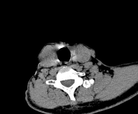 Carotid body tumor (Radiopaedia 61750-69757 Axial non-contrast 87).jpg