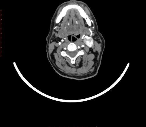 Carotid body tumor (Radiopaedia 66785-76116 B 36).jpg