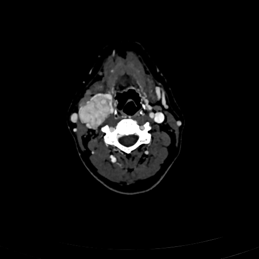 Carotid body tumor (Radiopaedia 83615-98727 D 59).jpg