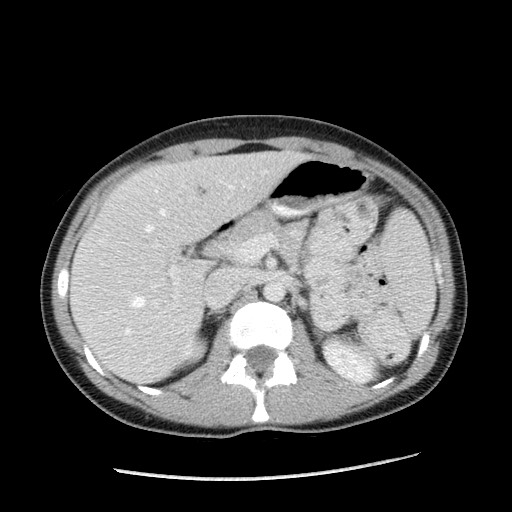 Castleman disease with fibrous pseudotumor in the abdomen (Radiopaedia 77296-89373 A 38).jpg