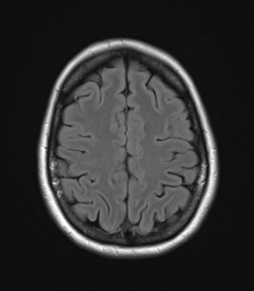File:Cavernoma with bleed - midbrain (Radiopaedia 54546-60774 Axial FLAIR 24).png