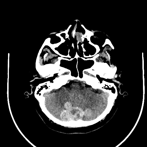 Cavernous hemangioma of the cerebellar falx (Radiopaedia 73025-83723 Axial non-contrast 28).jpg
