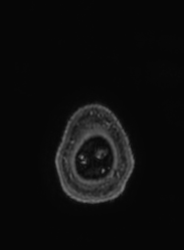 Cavernous hemangioma of the cerebellar falx (Radiopaedia 73025-83724 Axial T1 C+ 8).jpg