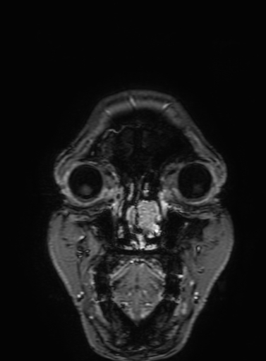 Cavernous hemangioma of the cerebellar falx (Radiopaedia 73025-83724 Coronal T1 C+ 26).jpg