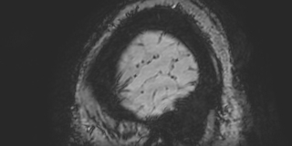Cavernous hemangioma of the cerebellar falx (Radiopaedia 73025-83724 Sagittal BOLD 193).jpg