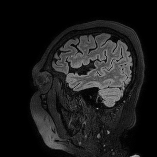 File:Cavernous hemangioma of the cerebellar falx (Radiopaedia 73025-83724 Sagittal FLAIR 183).jpg