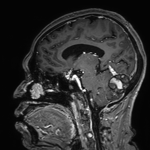 Cavernous hemangioma of the cerebellar falx (Radiopaedia 73025-83724 Sagittal T1 C+ 93).jpg