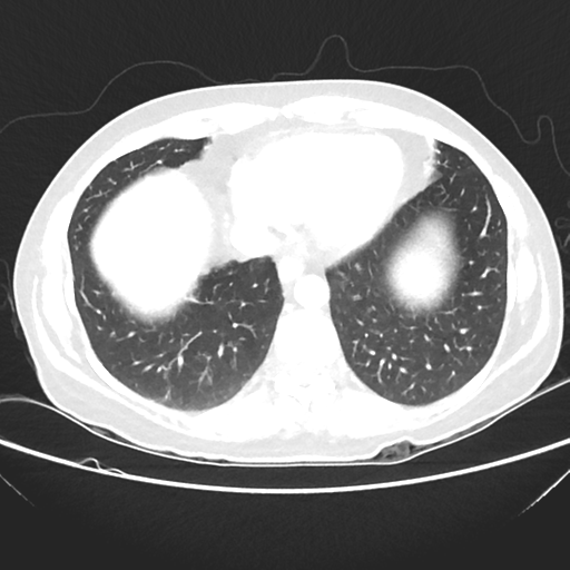 File:Cavitating lung mass - squamous cell carcinoma (Radiopaedia 48047-52854 Axial lung window 36).png