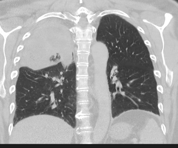 File:Cavitating pneumonia (Radiopaedia 45998-50329 Coronal lung window 33).png
