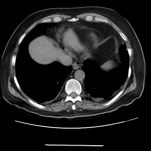 Cavitating pulmonary metastases (Radiopaedia 89545-106544 Axial non-contrast 43).jpg