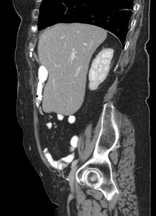 Cecal adenocarcinoma - surgical scar recurrence (Radiopaedia 79988-93264 D 47).jpg