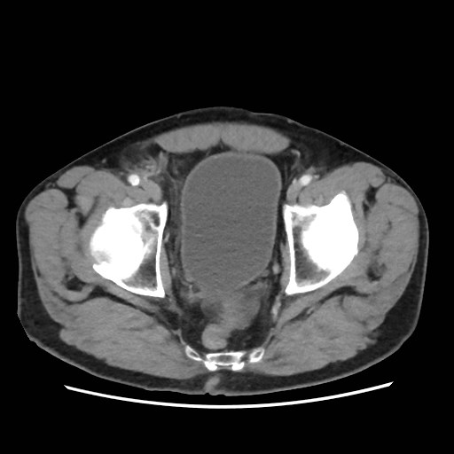 Cecal mass causing appendicitis (Radiopaedia 59207-66531 A 80).jpg