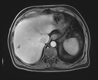 Cecal mass causing appendicitis (Radiopaedia 59207-66532 J 31).jpg