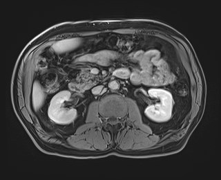 Cecal mass causing appendicitis (Radiopaedia 59207-66532 J 62).jpg