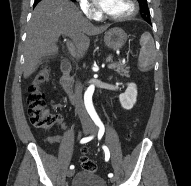 Celiac artery dissection (Radiopaedia 52194-58080 C 53).jpg