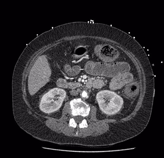 Celiac artery severe stenosis and dissection (Radiopaedia 44128-47842 B 41).jpg