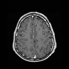 Central-variant posterior reversible encephalopathy syndrome (PRES) (Radiopaedia 43880-47358 Axial T1 C+ 130).jpg