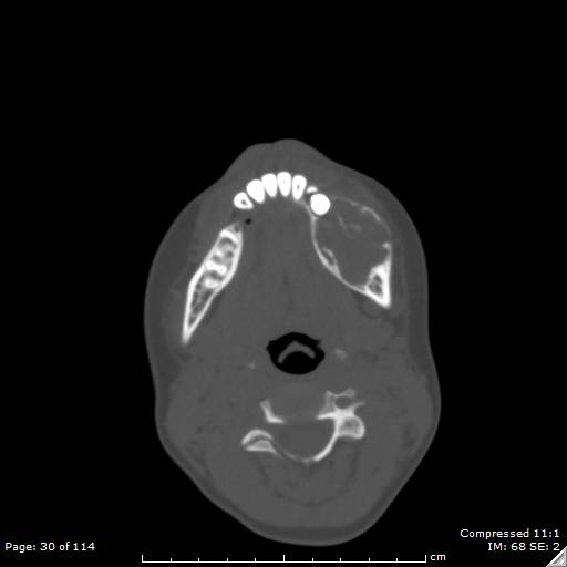 File:Central giant cell granuloma (Radiopaedia 45612-49754 Axial bone window 15).jpg
