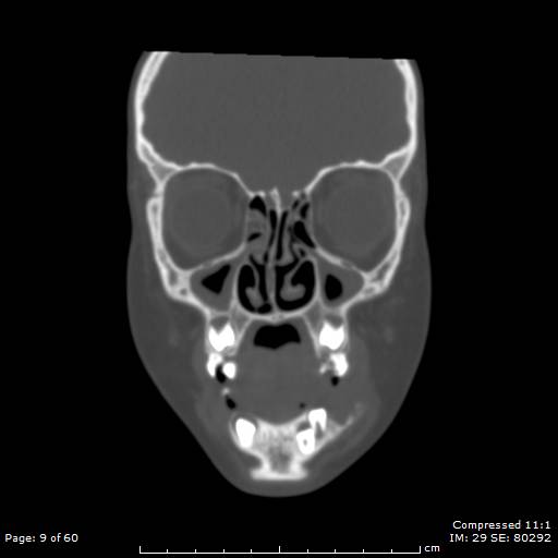 File:Central giant cell granuloma (Radiopaedia 45612-49754 Coronal bone window 9).jpg