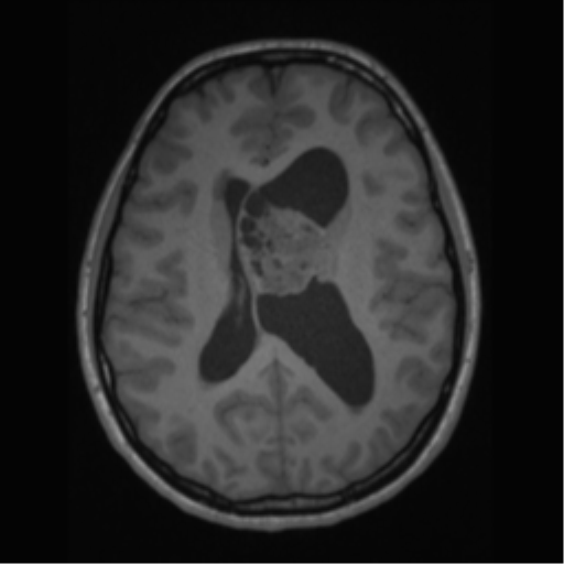 File:Central neurocytoma (Radiopaedia 37664-39557 Axial T1 43).png