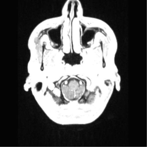 File:Central neurocytoma (Radiopaedia 37664-39557 Axial T1 C+ 10).png