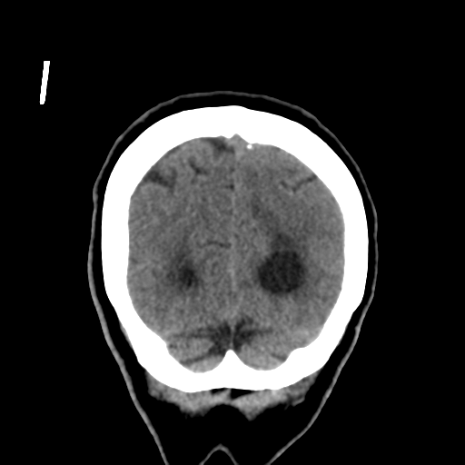 Central neurocytoma (Radiopaedia 65317-74346 Coronal non-contrast 52).png
