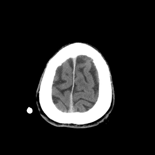 Central neurocytoma (Radiopaedia 68725-78432 Axial C+ 85).jpg
