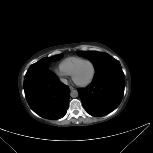 Centrilobular pulmonary emphysema (Radiopaedia 24495-24789 Axial non-contrast 35).jpg