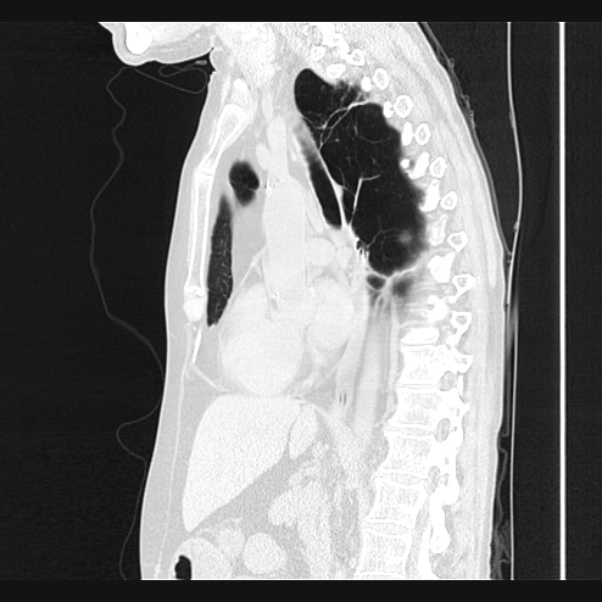 Centrilobular pulmonary emphysema (Radiopaedia 24495-24789 Sagittal lung window 40).jpg
