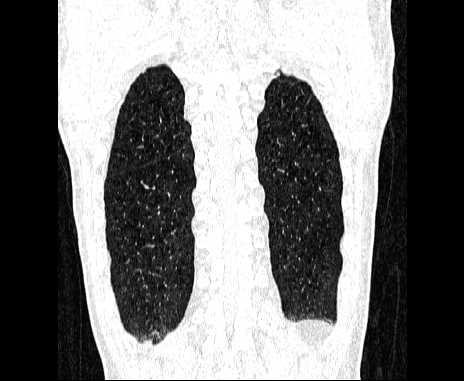 Centrilobular pulmonary emphysema (Radiopaedia 62468-70718 Coronal lung window 64).jpg