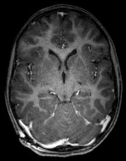 Cerebellar abscess (Radiopaedia 73727-84563 Axial T1 C+ fat sat 59).jpg