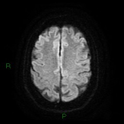 Cerebellar abscess (Radiopaedia 78135-90678 Axial DWI 22).jpg