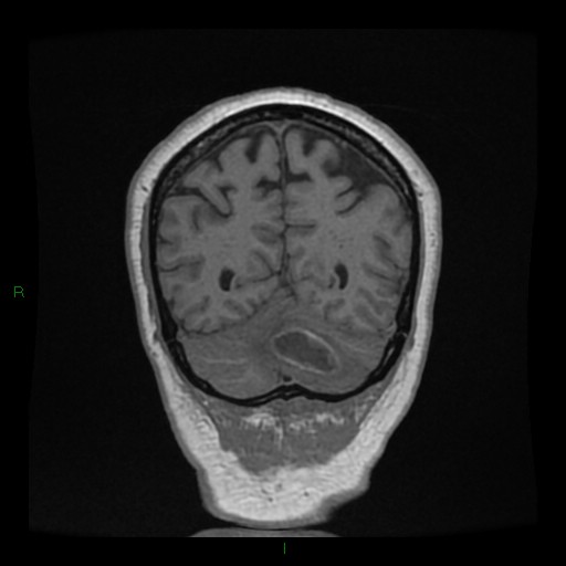 Cerebellar abscess (Radiopaedia 78135-90678 Coronal T1 C+ 131).jpg