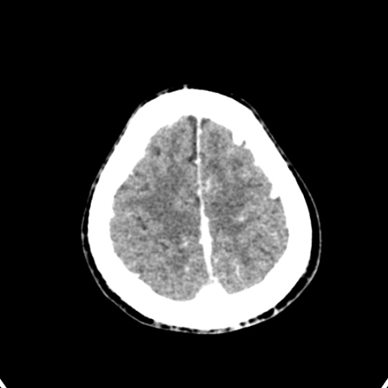 Cerebellar abscess secondary to mastoiditis (Radiopaedia 26284-26412 Axial C+ delayed 135).jpg