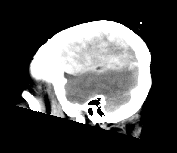 File:Cerebellar ependymoma complicated by post-operative subdural hematoma (Radiopaedia 83322-97737 C 6).png