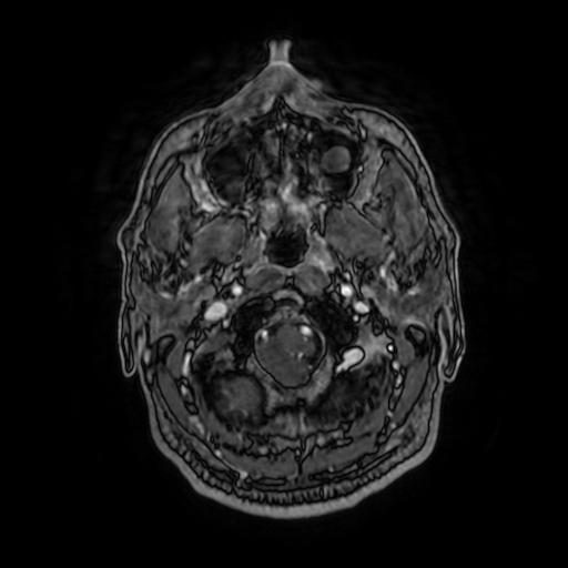Cerebellar hemangioblastoma (Radiopaedia 88055-104622 Axial T1 C+ 29).jpg