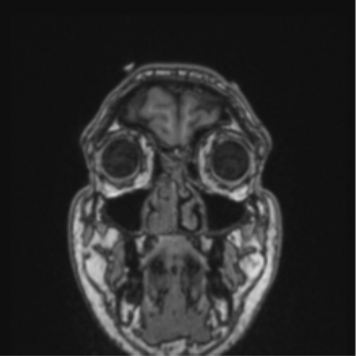Cerebellar hemangioblastomas and pituitary adenoma (Radiopaedia 85490-101176 Coronal T1 81).png