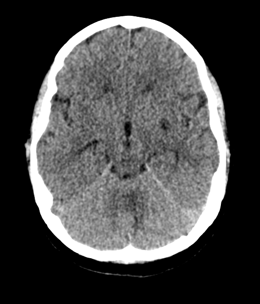 Cerebellar metastases - colorectal adenocarcinoma (Radiopaedia 40947-43652 Axial non-contrast 24).png