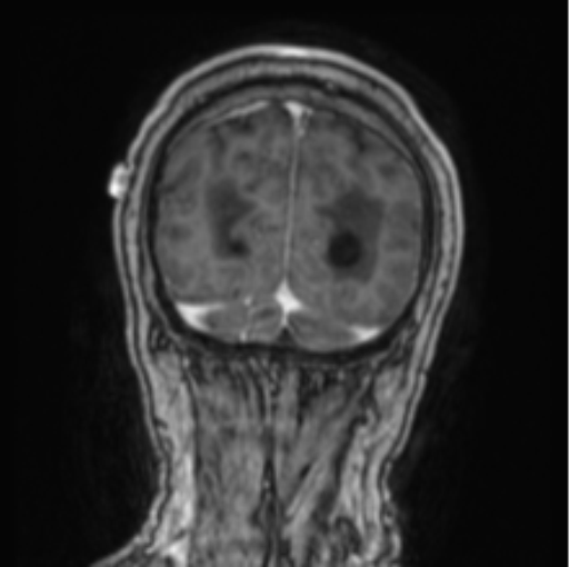 Cerebellar metastasis from lung adenocarcinoma (Radiopaedia 86690-102829 Coronal T1 C+ 16).png