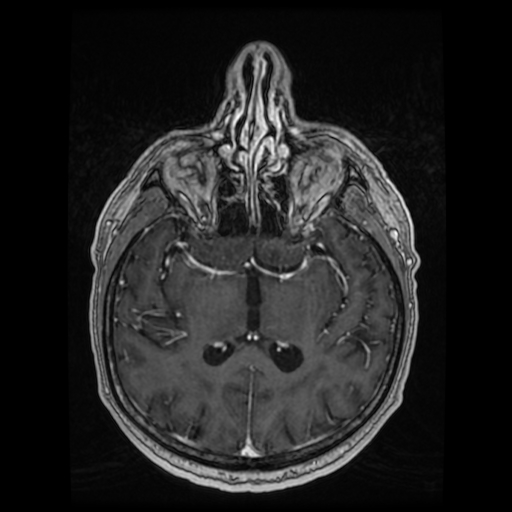 Cerebellar metastasis of pulmonary adenocarcinoma, cavernous venous malformation, and developmental venous anomaly (Radiopaedia 85827-101661 Axial T1 C+ 52).jpg