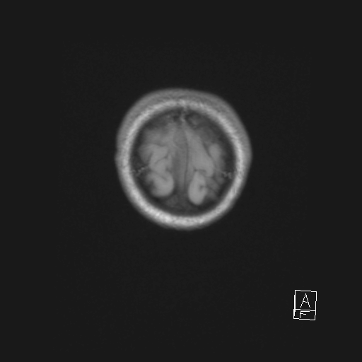 Cerebellar stroke (Radiopaedia 32202-33150 Coronal T1 62).png