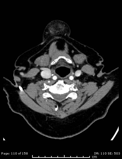 Cerebellar strokes due to intracranial giant cell arteritis (Radiopaedia 68799-78510 CT angiogram 110).jpg