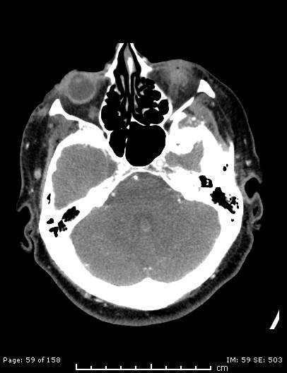 File:Cerebellar strokes due to intracranial giant cell arteritis (Radiopaedia 68799-78510 CT angiogram 59).jpg
