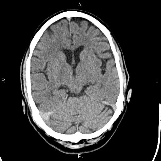 Cerebellopontine angle arachnoid cyst (Radiopaedia 85149-100704 Axial With contrast 21).jpg