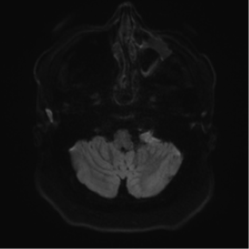 Cerebellopontine angle meningioma (Radiopaedia 48434-53348 Axial DWI 42).png