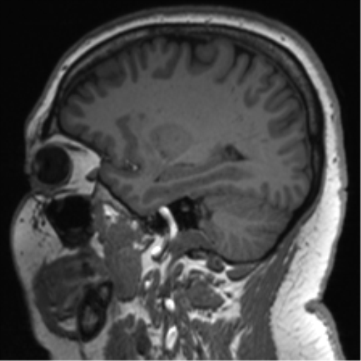 Cerebellopontine angle meningioma (Radiopaedia 48434-53348 Sagittal T1 62).png
