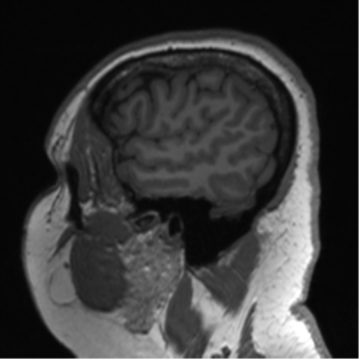 File:Cerebellopontine angle meningioma (Radiopaedia 48434-53348 Sagittal T1 75).png